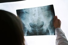 Řídnutí kostí neboli osteoporóza